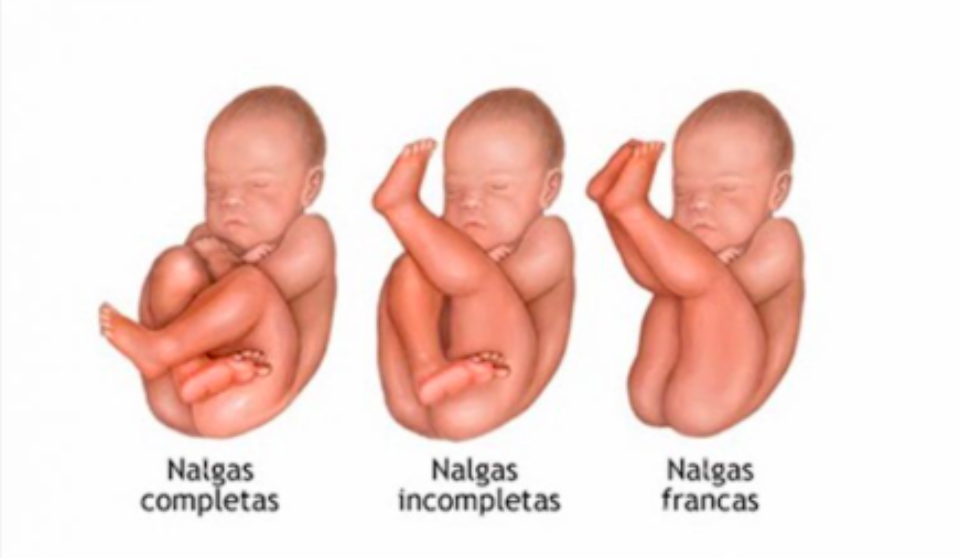 Ilustración médica detallada de las tres principales variantes de la presentación podálica de un bebé de nalgas: nalgas completas, nalgas incompletas y nalgas francas, usadas por la matrona Elena para explicar la biomecánica en A Solas con tu Matrona, Madrid.