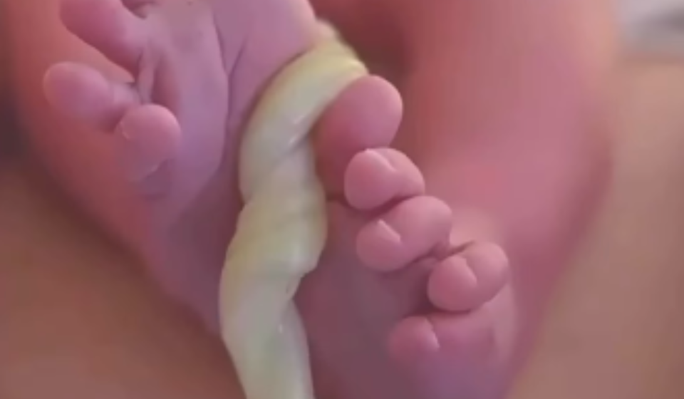 Recién nacido con el cordón umbilical aún unido tras el parto, ejemplo de pinzamiento tardío del cordón umbilical