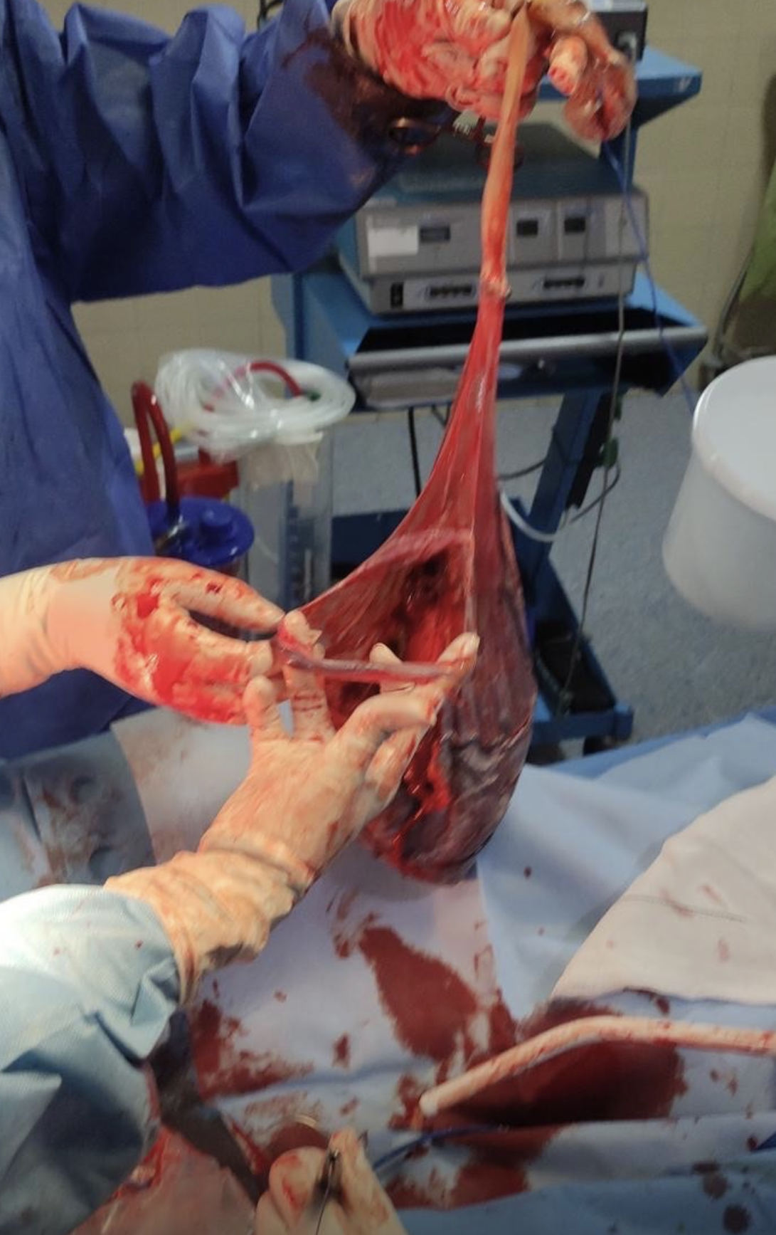 Ilustración médica de una placenta con el cordón umbilical y las membranas expuestas tras el alumbramiento, mostrando la red de vasos sanguíneos. Imagen didáctica usada en el blog de A Solas con tu Matrona, Madrid.